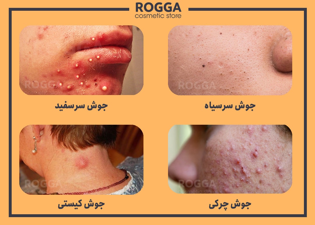 انواع جوش و آکنه